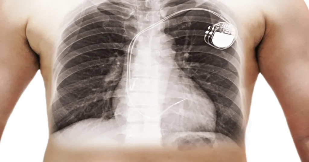 What You Need to Know About Pacemakers Heart Matters