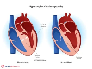 Understanding Hypertrophic Cardiomyopathy: Causes, Symptoms, and Management Heart Matters