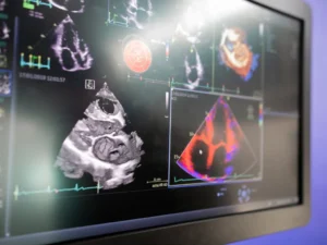 Sound Waves and Heart Health: The Echocardiogram Explained Heart Matters