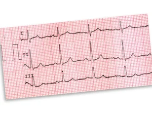 The Electrocardiogram (ECG / EKG) Heart Matters