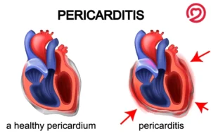 Chest Pain: Understanding Symptoms, Causes, and Evaluation Heart Matters