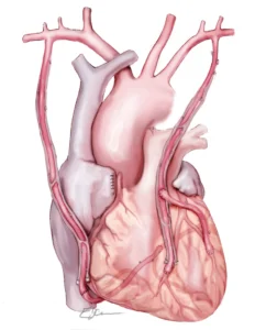Coronary Artery Bypass Grafting (CABG): <br>What to expect Heart Matters