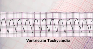 Understanding Ventricular Tachycardia: A Potentially Life-Threatening Arrhythmia Heart Matters