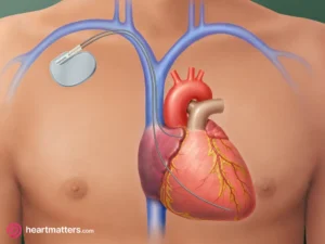 Leadless Pacemakers: Advancing Cardiac Care with Promising Results Heart Matters