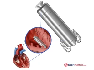 Leadless Pacemakers: Advancing Cardiac Care with Promising Results Heart Matters