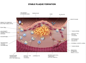 What is Atherosclerosis? Heart Matters