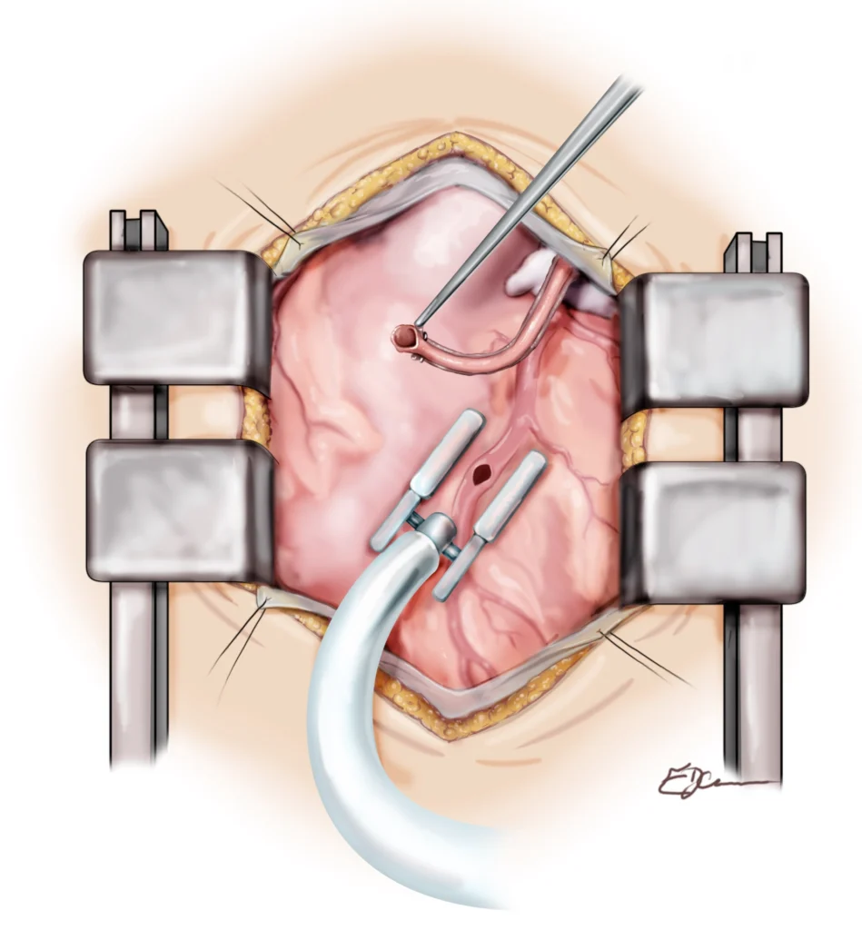Coronary Artery Bypass Grafting (CABG): <br>What to expect Heart Matters