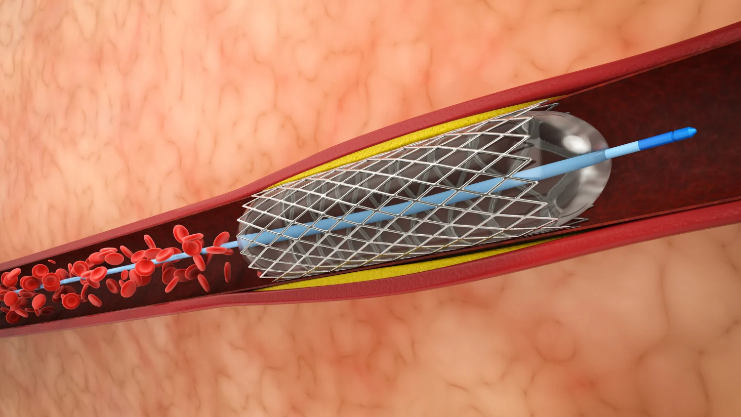 A coronary stent being deployed inside a narrowed artery, shown in cross-section