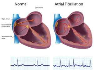 Treatment Strategies for Atrial Fibrillation (AF) Heart Matters