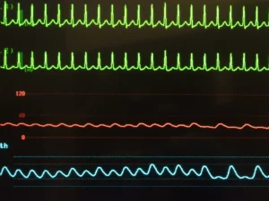 New simple intranasal drug treatment for SVT Heart Matters