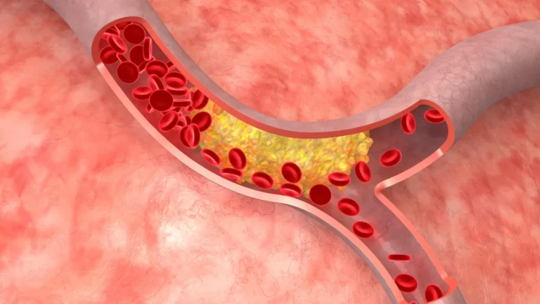 What Is Atherosclerosis?