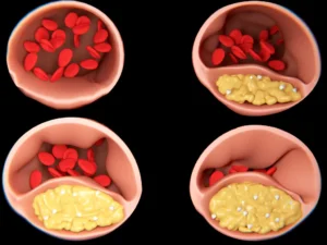 What is Atherosclerosis? Heart Matters