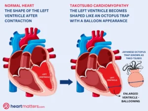 Understanding Takotsubo Cardiomyopathy: The Broken Heart Syndrome Heart Matters