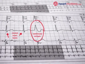 Palpitations and Ventricular Ectopics: Causes, Symptoms, and Management Heart Matters