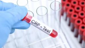The hs-CRP Test: Inflammation, Heart Risk, and Why Context Matters