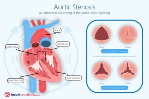 Understanding Aortic Stenosis: Symptoms, Causes, Diagnosis, and Treatment Heart Matters