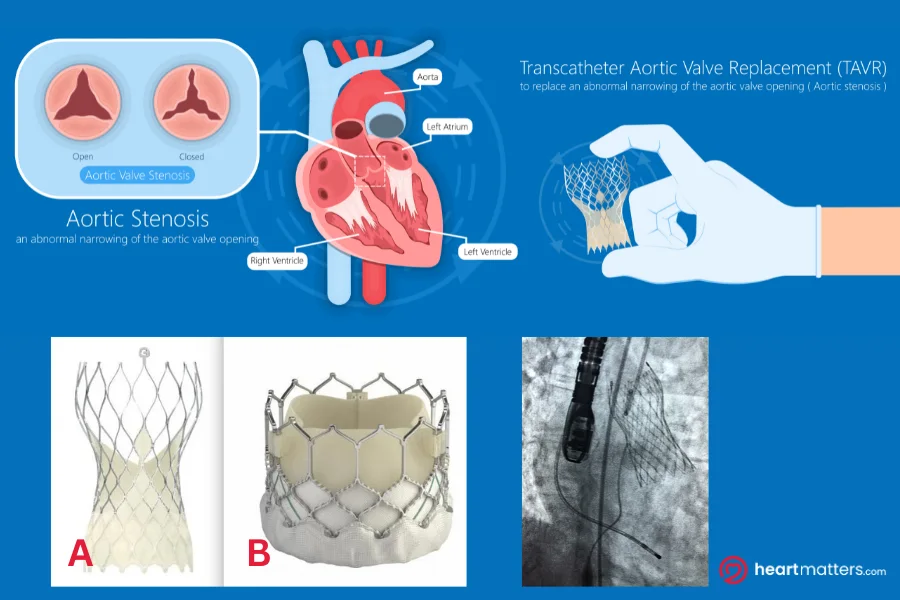 CoreValve and Edwards Sapien 3 TAVR valve devices