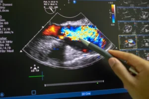 What is a Transesophageal Echocardiogram (TEE)? Heart Matters