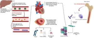 Cardiac Amyloidosis: An Uncommon but Important Cause of a 'Stiff' Heart Heart Matters