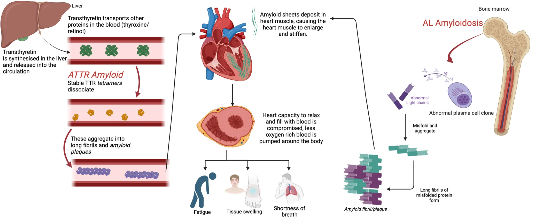 Diagram showing AL and ATTR amyloidosis protein pathways