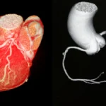 CT Coronary Angiogram (CTCA): What It Is, What to Expect, and What It Shows