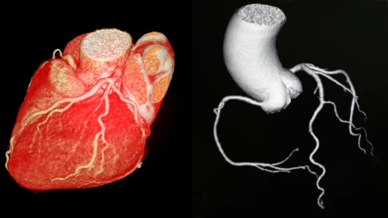 CT Coronary Angiogram (CTCA): What It Is, What to Expect, and What It Shows