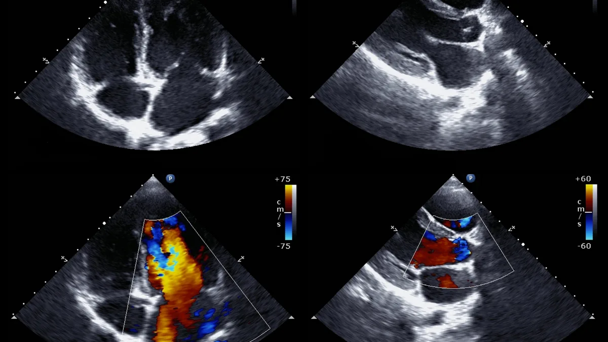 Echocardiogram apical four-chamber view showing the left and right ventricles and atria, used to assess chamber size, wall motion, and ejection fraction