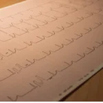 An Isolated Inferior Q Wave on Your ECG: Why It’s Usually Nothing to Worry About