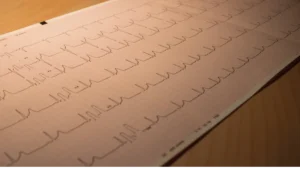 An Isolated Inferior Q Wave on Your ECG: Why It’s Usually Nothing to Worry About