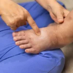Ankle Swelling: Causes, Assessment, and When It Matters
