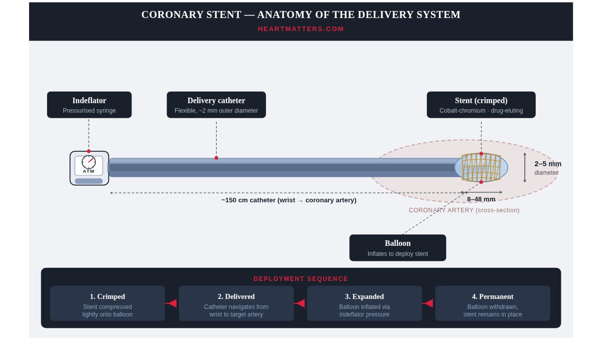 Diagram showing the anatomy of a coronary stent delivery system, including the indeflator, delivery catheter, balloon, and crimped stent mesh, with a four-step deployment sequence