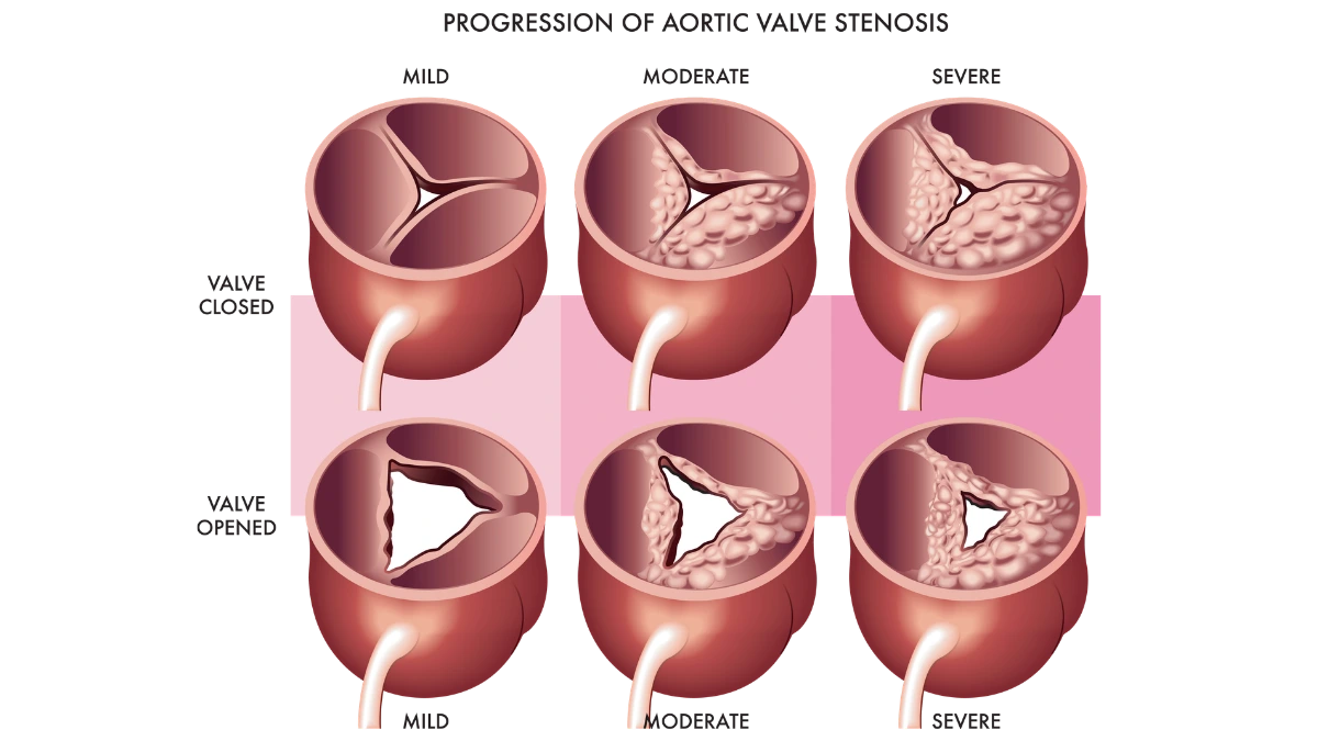 Diagram showing the progression of aortic stenosis
