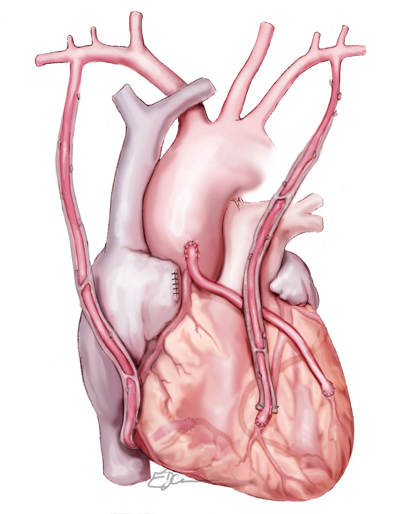 Illustration of bilateral internal mammary artery grafting, with both left and right mammary arteries used as bypass grafts