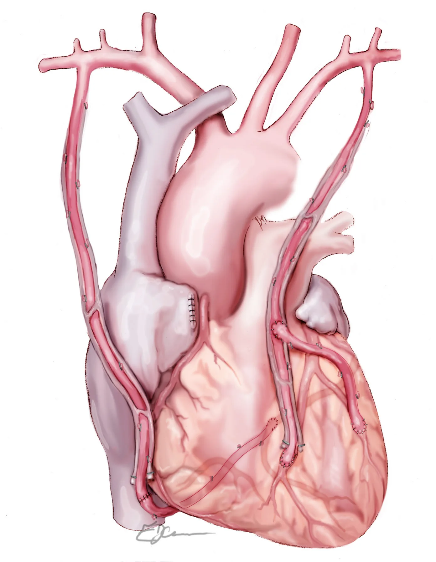 Illustration of maximum arterial revascularisation, combining both mammary arteries with a radial artery graft