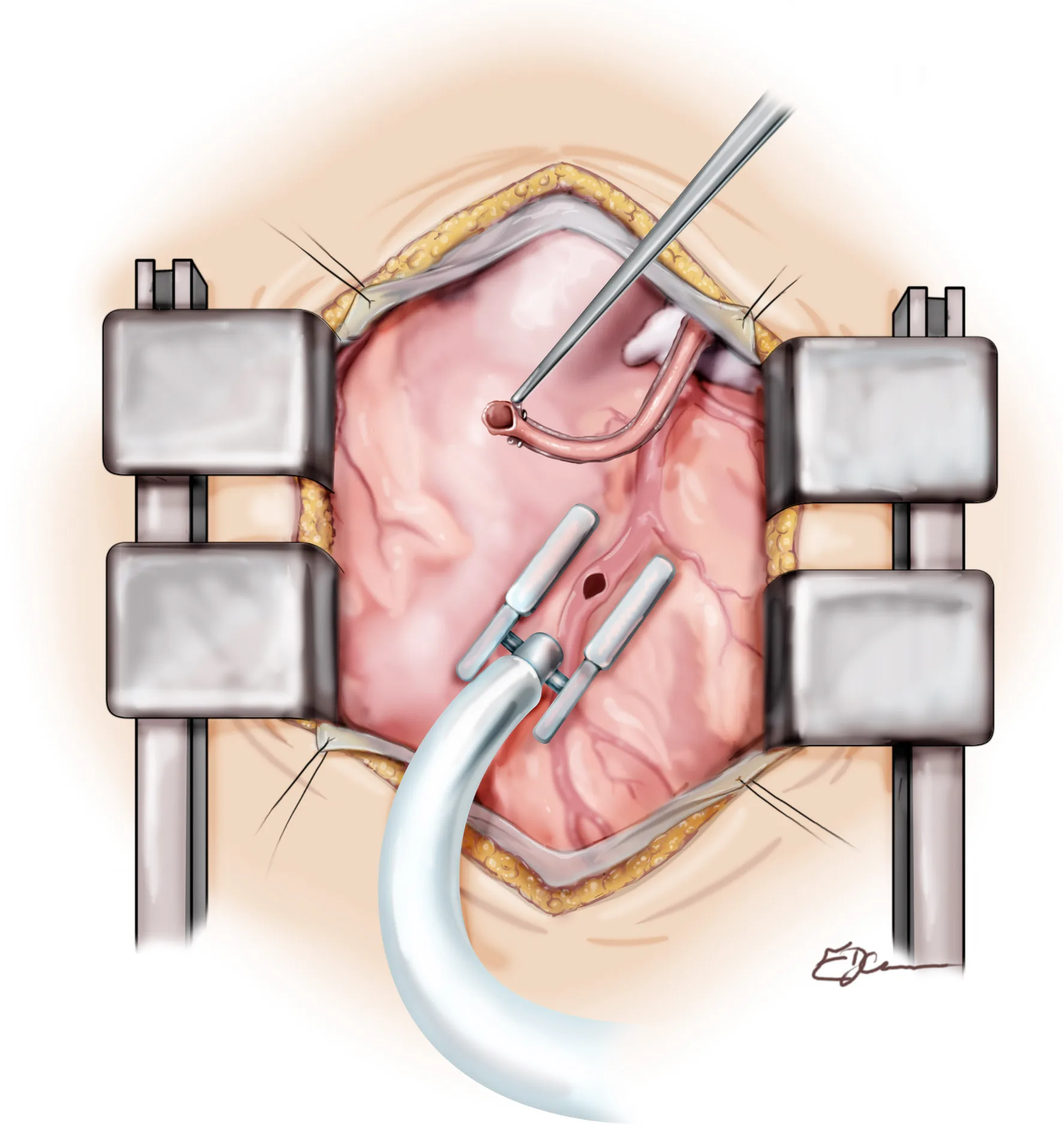 View inside the operative field during beating-heart bypass surgery through a median sternotomy