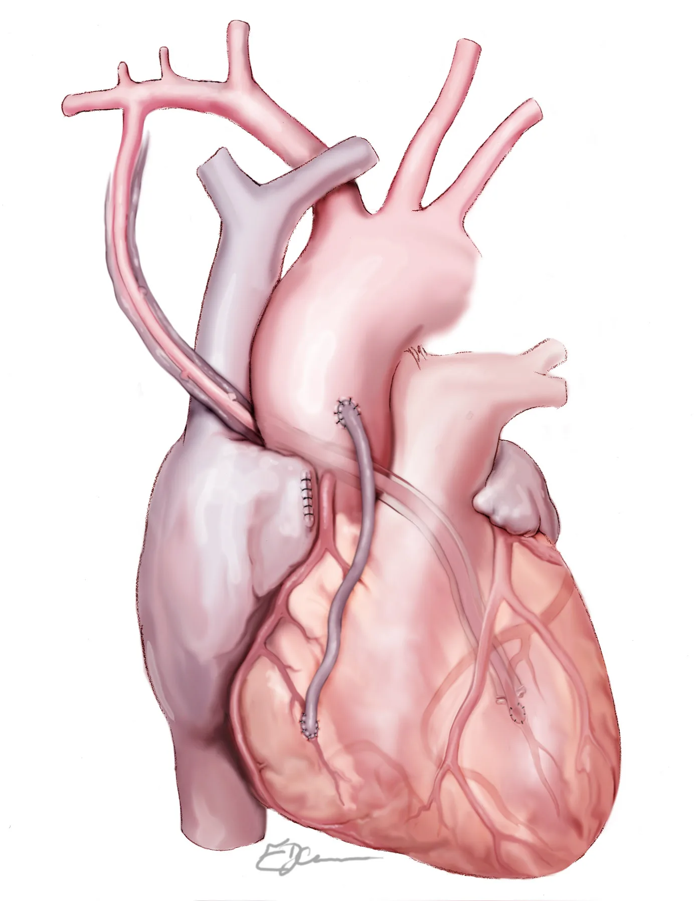 Illustration showing a traditional bypass arrangement with mammary artery to LAD and a vein graft to the right coronary territory