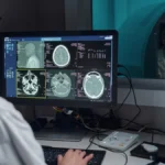Stroke and TIA Explained