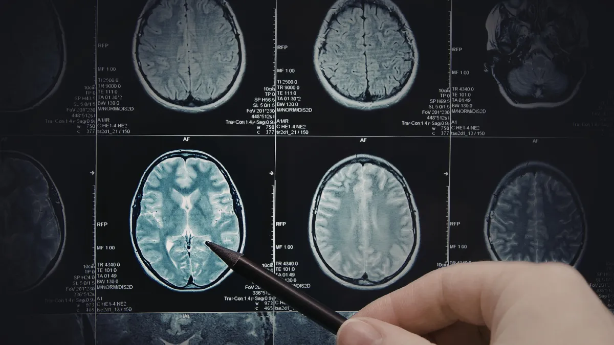 MRI brain scan used to assess stroke and guide treatment