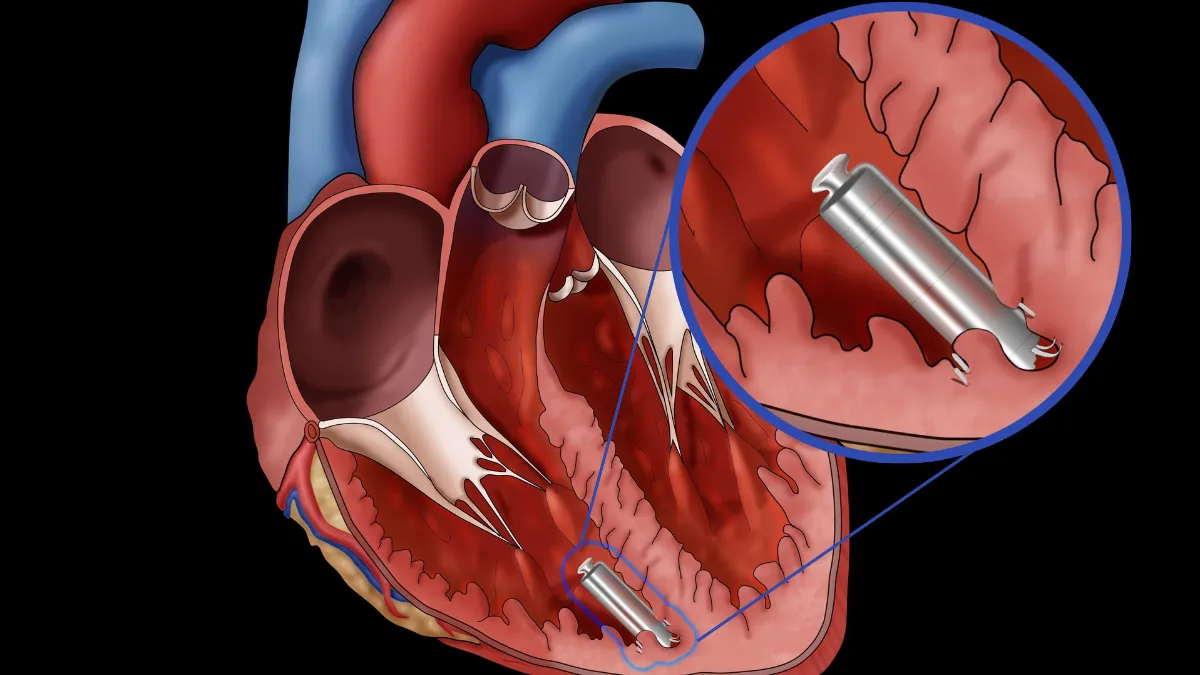 Leadless pacemaker anchored inside the right ventricle
