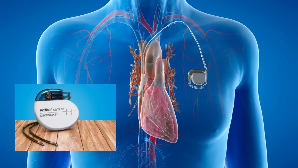 Diagram showing conventional pacemaker with generator and leads from subclavian vein to right atrium and right ventricle