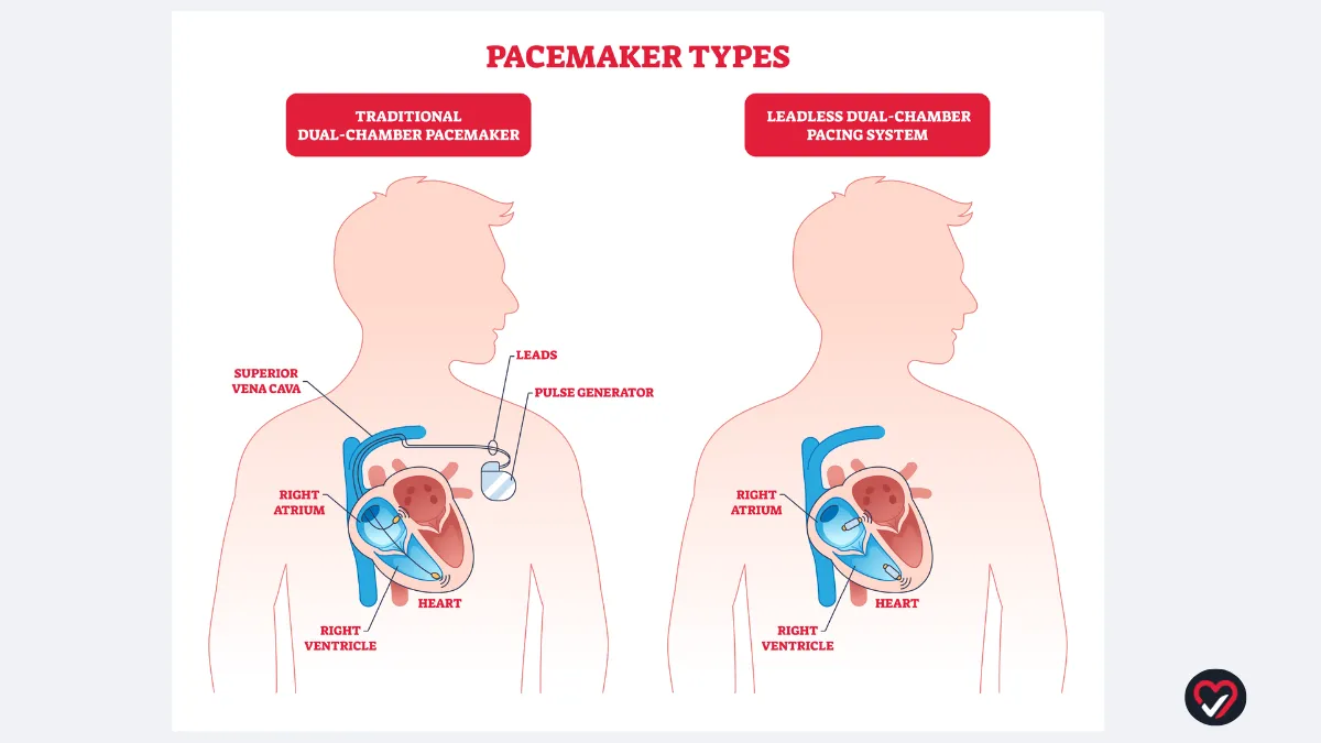 Side by side comparison of traditional dual-chamber pacemaker and leadless dual-chamber pacing system