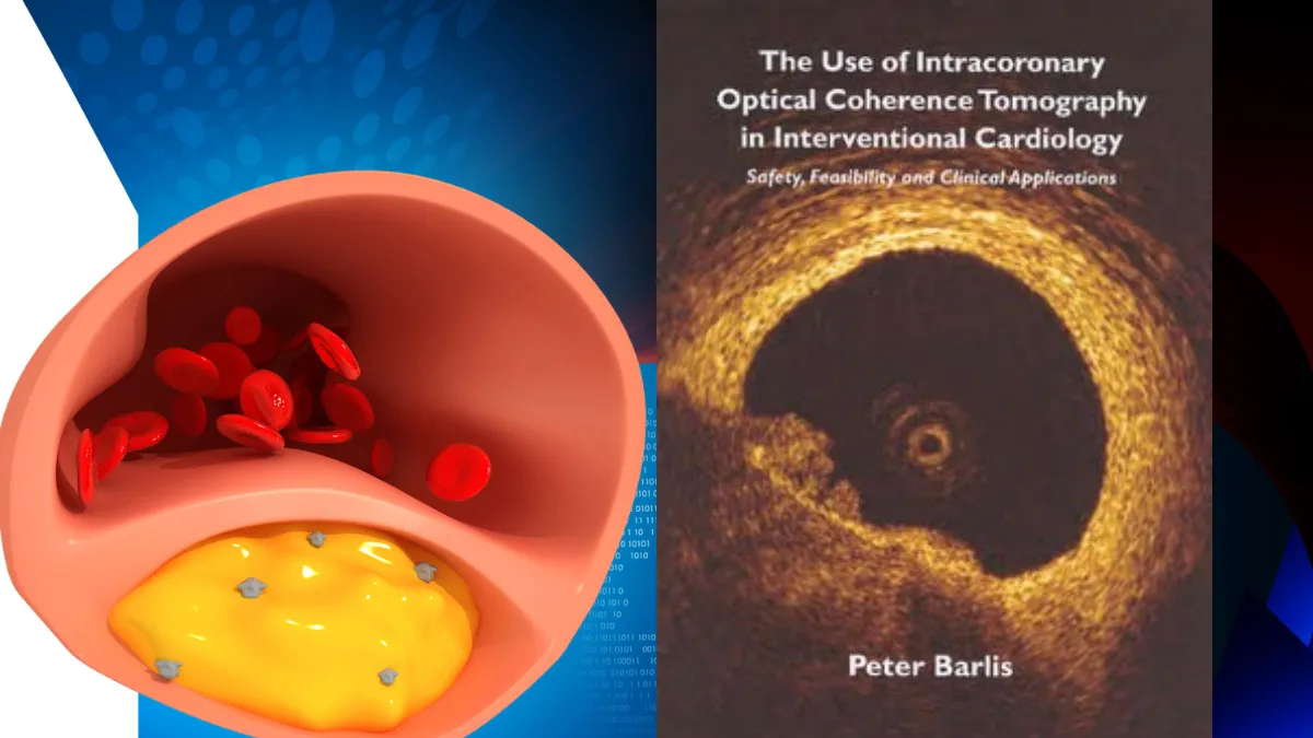 Cross-section illustration of a coronary artery showing a lipid-rich plaque with inflammatory cells, alongside an actual OCT image from Prof. Peter Barlis's PhD thesis showing the view from inside a coronary artery