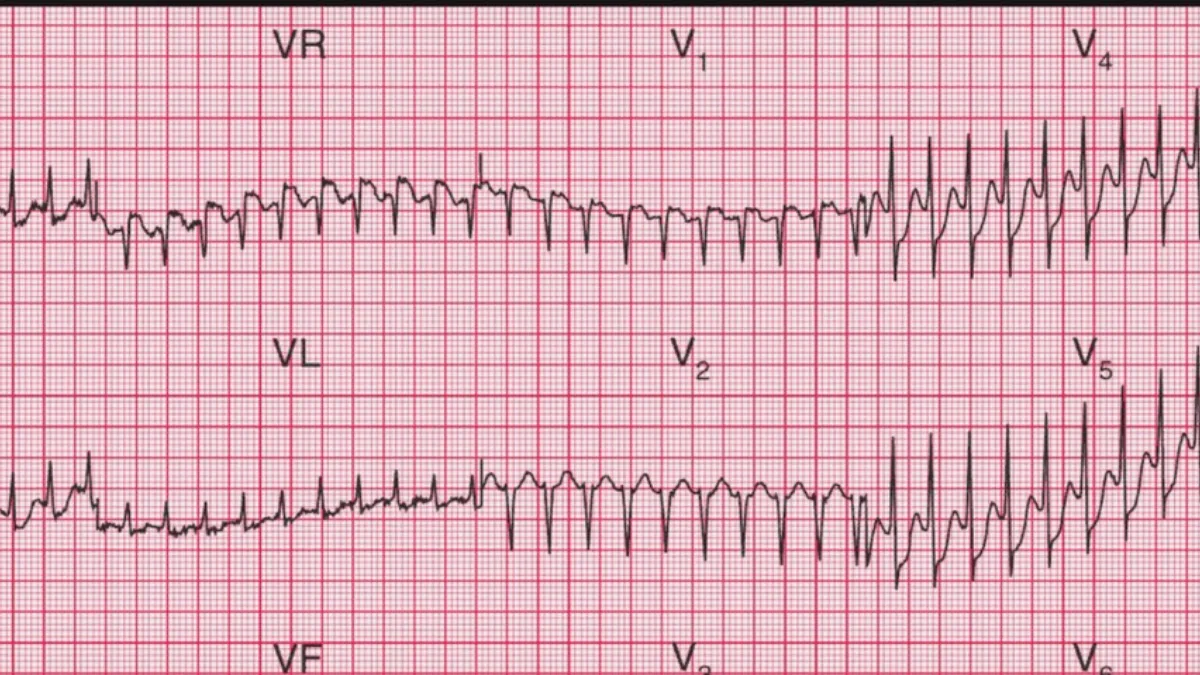 ECG trace showing AVNRT - the most common form of supraventricular tachycardia