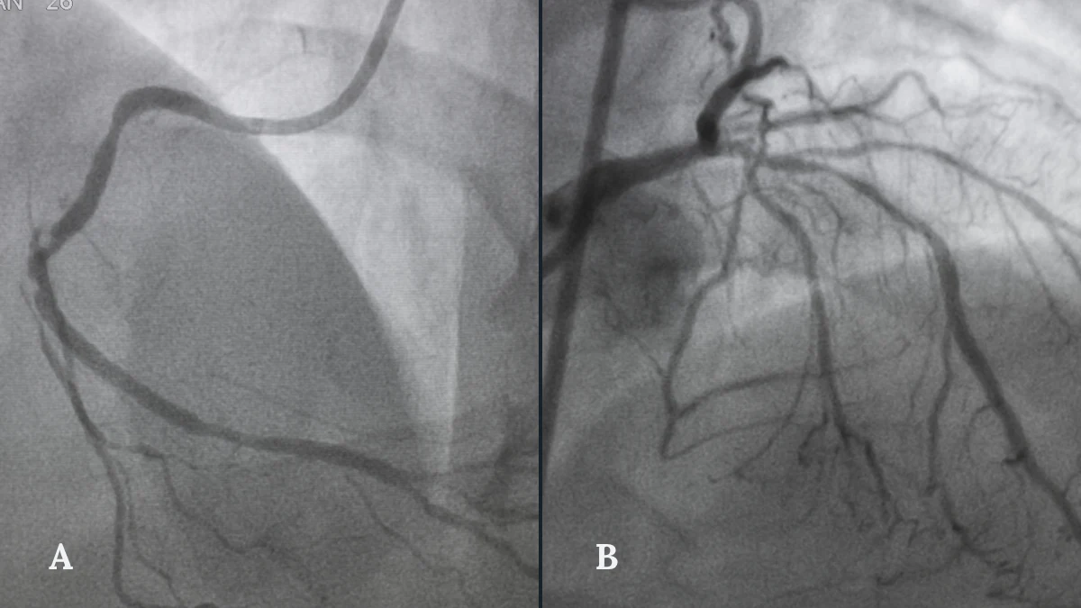Coronary angiogram showing the heart arteries