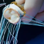 Aortic Stenosis: When the Heart’s Gateway Narrows