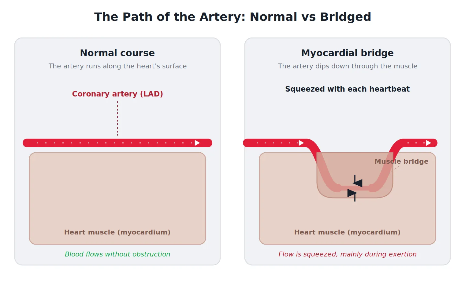 Diagram comparing a normal coronary artery running along the heart surface with a myocardial bridge, where the artery dips down through the heart muscle and is squeezed with each heartbeat.