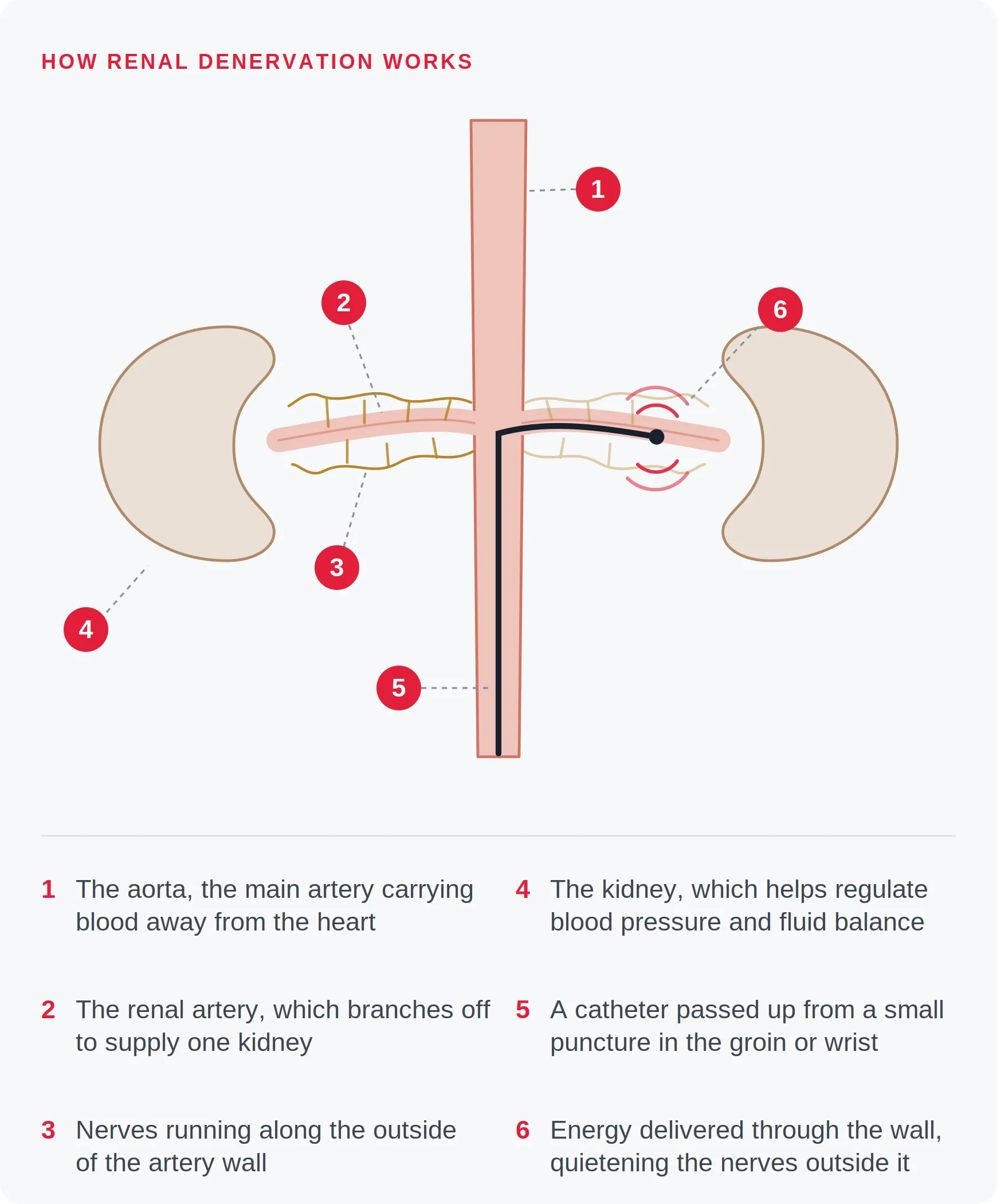 Diagram of renal denervation showing the aorta, the renal artery supplying each kidney, the nerves running along the outside of the artery wall, and a catheter delivering energy through the artery wall to quieten those nerves.