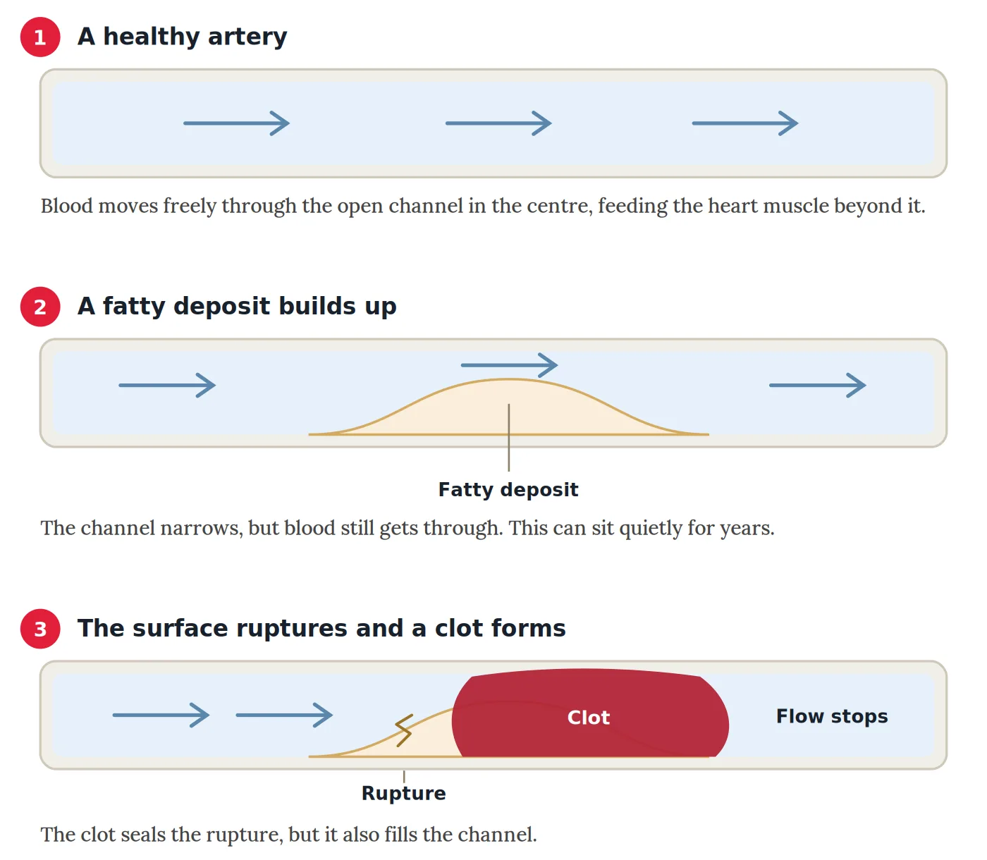Clot-Busting Drugs: When a Heart Attack Is Hours From Help 3 Three stage diagram: a healthy artery with blood flowing freely, an artery narrowed by a fatty deposit, and an artery blocked by a clot after the deposit ruptures
