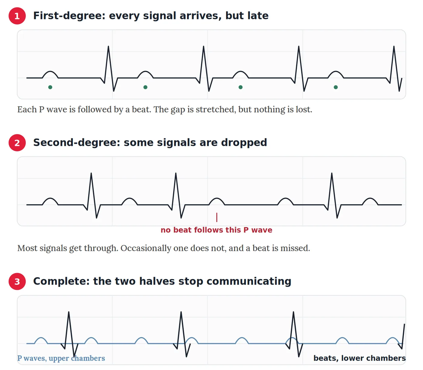 Complete Heart Block: What It Means and How It's Treated 3 Three ECG tracings compared. In first-degree block every P wave is followed by a beat after a long delay. In second-degree block some P waves are not followed by a beat. In complete heart block the P waves and the beats are entirely independent of each other