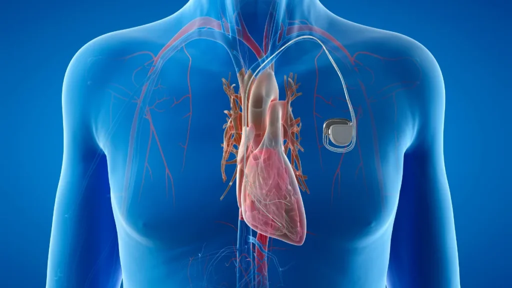 Complete Heart Block: What It Means and How It’s Treated